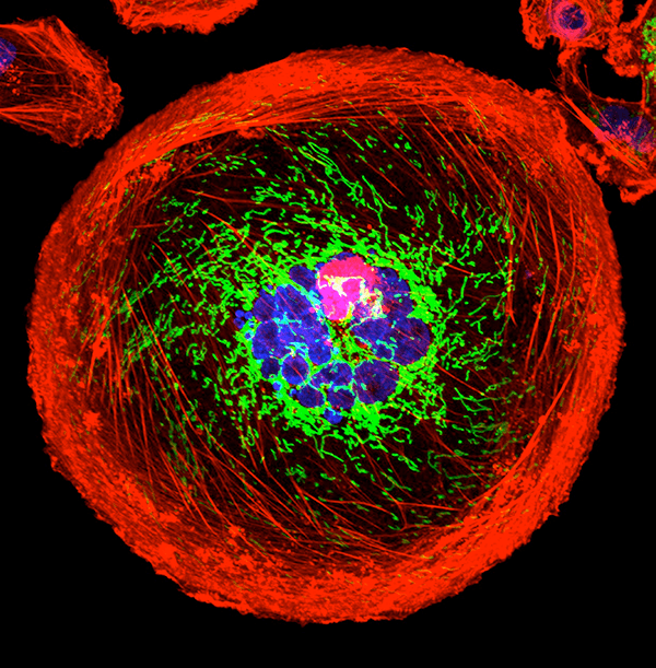 Micrograph shows a polyploid giant cancer cell (PGCC) from a triple-negative breast cancer. Actin is red; mitochondria are green; nuclear DNA is blue.