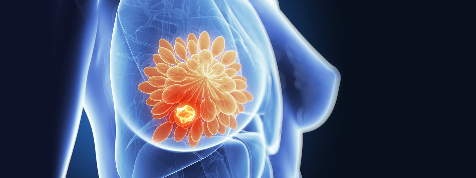 Unraveling breast cancer risk