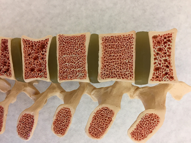 A photo of a medical model shows sections through five vertebrae, revealing the pink, internal bone matrix. Some of the vertebrae have larger holes in them than others.