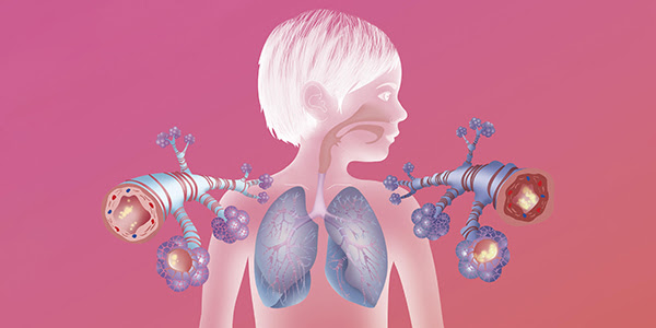 Lungs and airways of a person with asthma showing inflammation of airways and mucus collecting within airways.