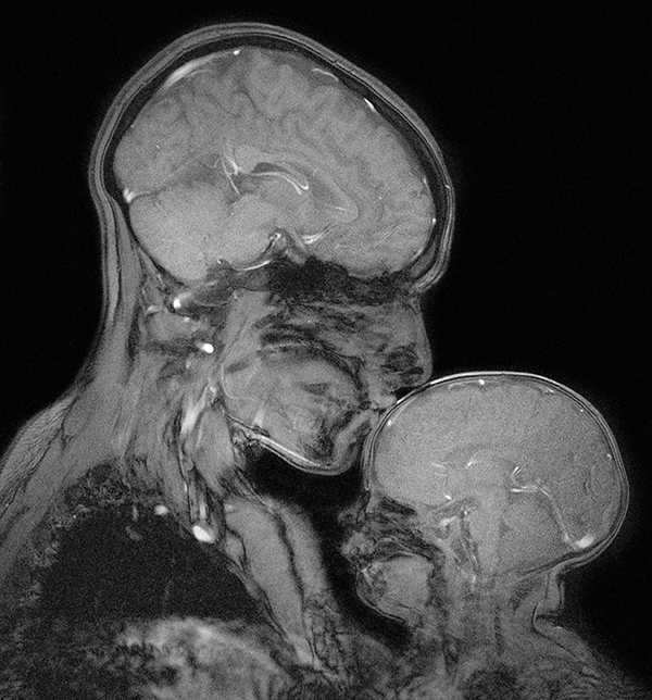 An MRI scan shows a black-and-white side-view of an adult and a baby embracing. Their brains, necks and shoulders are visible.
