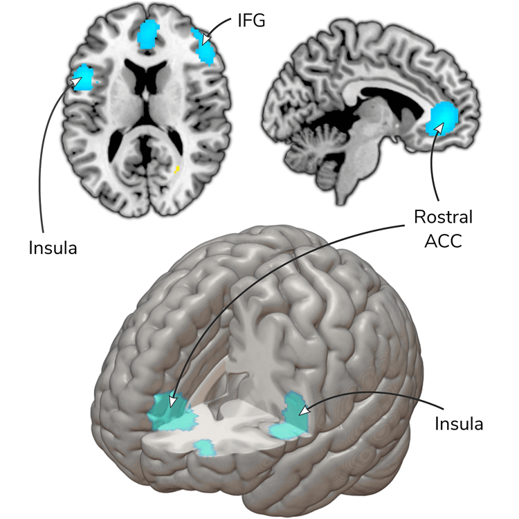 Illustration of brain showing regions where activity decreases after psychotherapy, as determined by brain scans.