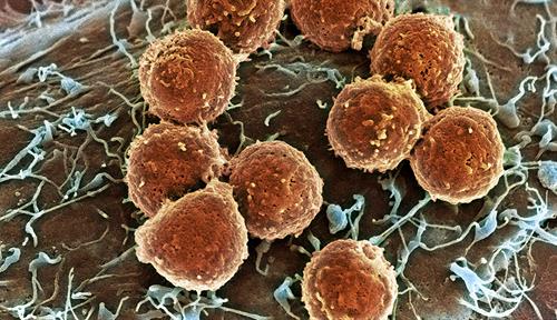 Colorized scanning electron microscopy image shows round orange blobs (T cells) on top of an irregularly shaped cell with lots of hairy projections (a tumor cell).