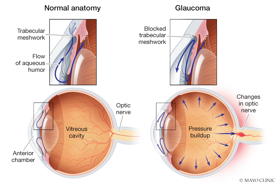 Schematic diagram shows what goes wrong in glaucoma. A normal eye is contrasted with an eye with glaucoma in which fluid doesn’t drain properly because of a blockage in the trabecular meshwork.