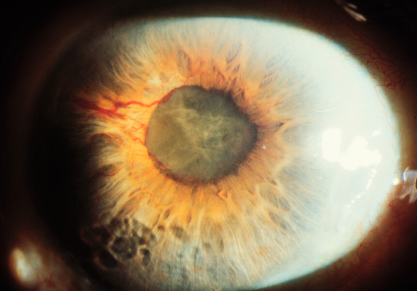 Close-up front view photograph of an eye of someone with glaucoma, the lens appears cloudy.