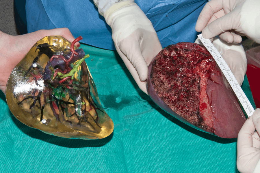 Photograph of a 3-D-printed liver lobe shown next to the real lobe.