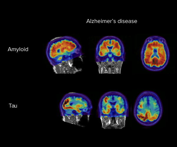 Amyloid- and tau-specific PET brain scans highlight areas of the brains that are distinctly affected in an Alzheimer’s patients.