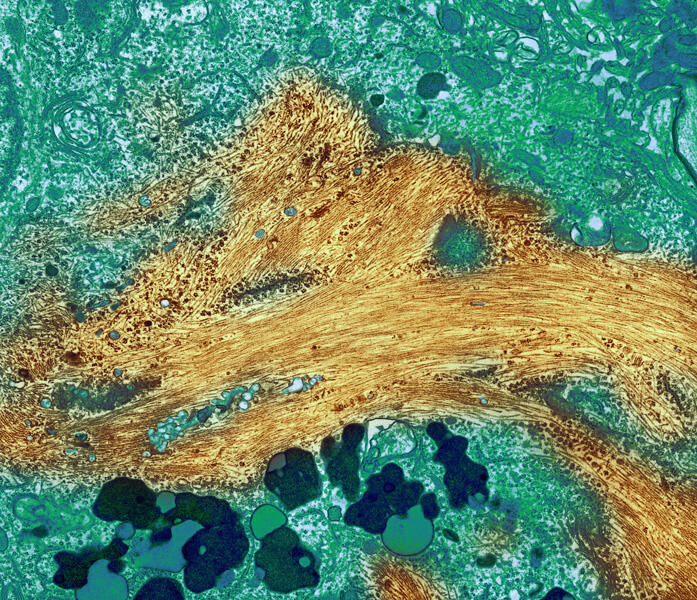 A microscopic image of brain tissue shows a large accumulation of tau protein, falsely colored yellow.