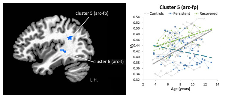 Brain image showing location of two regions involved in stuttering. Also, a graph showing improvement in connectedness of one of these regions in children whose stutter gets better, while persistent stutterers show no improvement.