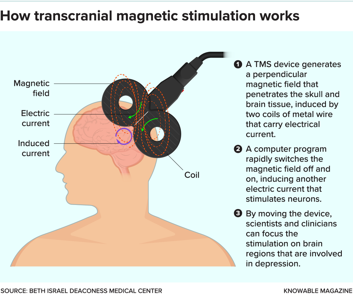 An illustration showing a flat TMS device positioned over the left side of a person’s head, emitting a perpendicular magnetic field.