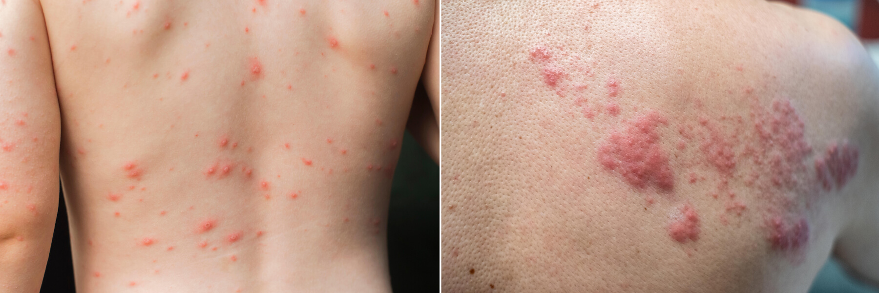 Photograph of two backs with red welts on them. The one on the left is a chickenpox rash and the one on the right, a case of shingles.