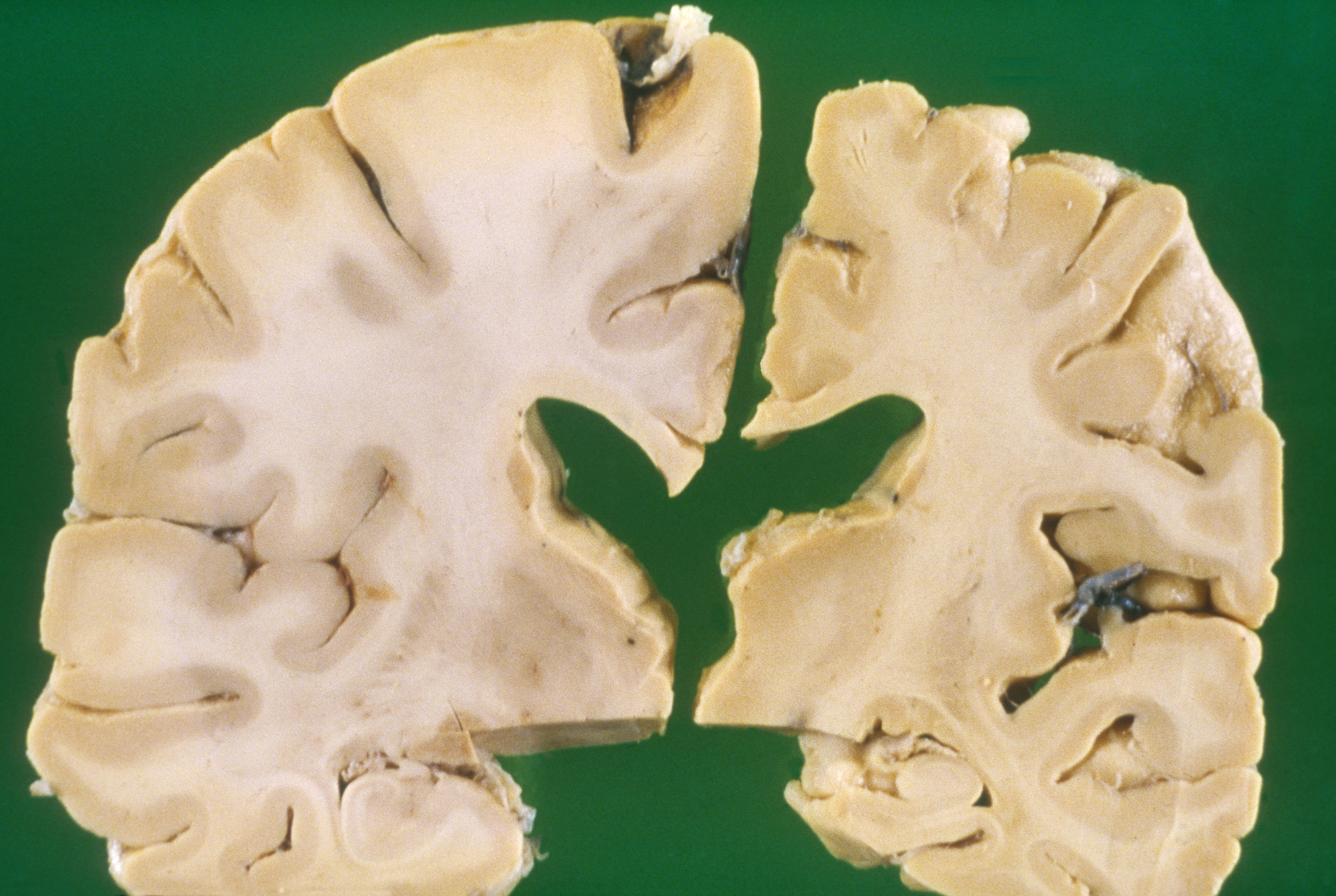 A slice of brain from an Alzheimer’s patient is compared to a slice from a normal adult.