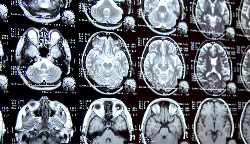 Photo of an MRI head scan. Nearly 400 million MRIs, X-rays, ultrasounds and other types of medical scans are done each year in the USA.