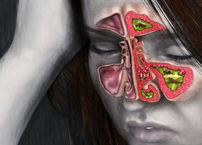 Snot what you think: The unknown toll of chronic sinus problems
