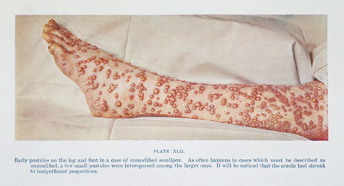 A plate from a textbook shows a leg riddles with red pustules, text describes unmodified smallpox pustule characteristics.