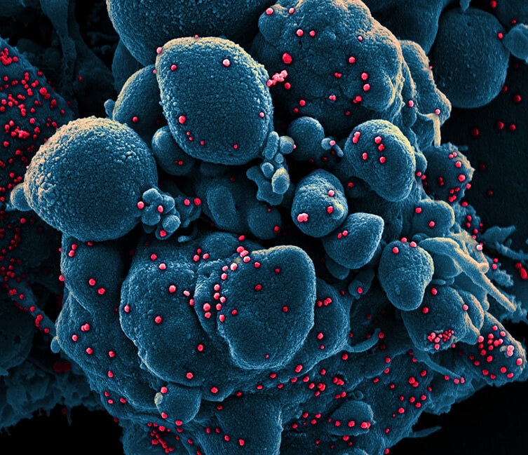 Scanning electron micrograph of a cell (colored blue) infected with SARS-COV-2 virus particles (colored red).