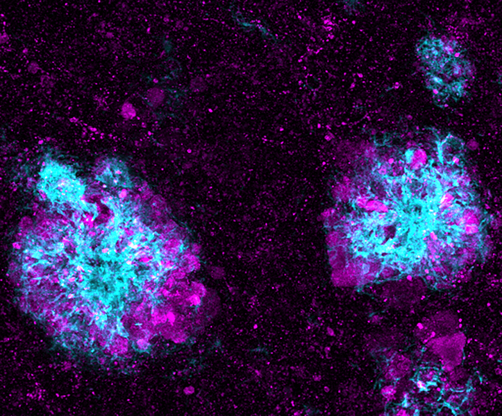 Microscopic image shows amyloid plaques surrounded by lysosomes.