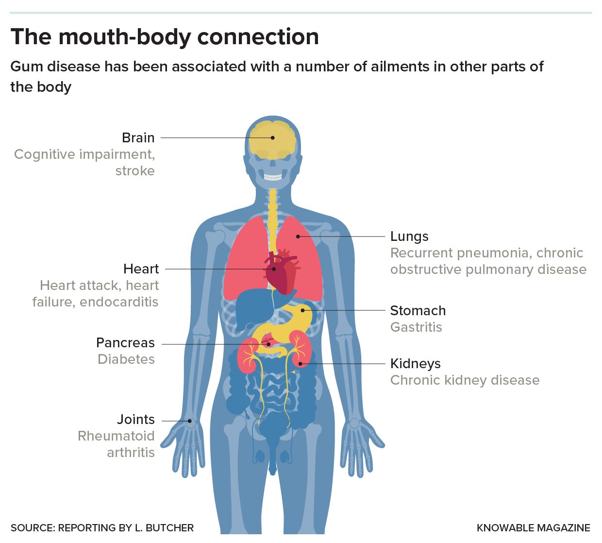 Diagram of a body highlighting the various organs affected by poor dental health