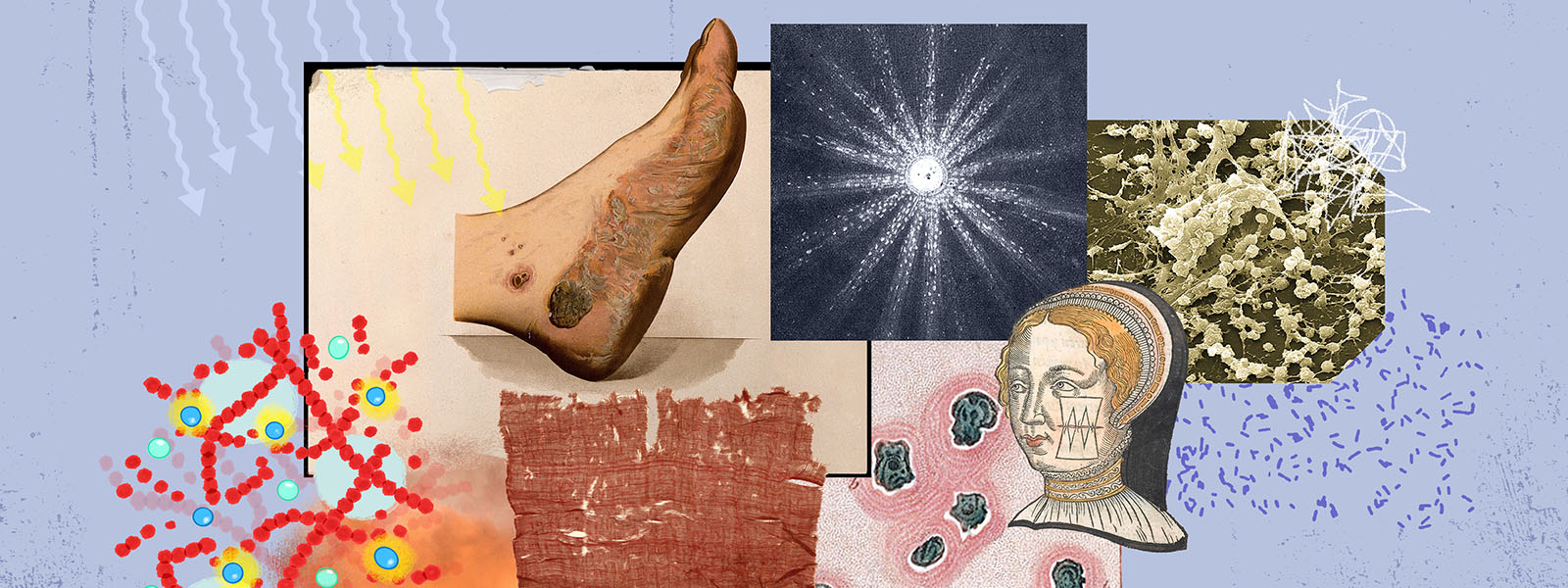 Illustration shows infected wounds, bacteria and light