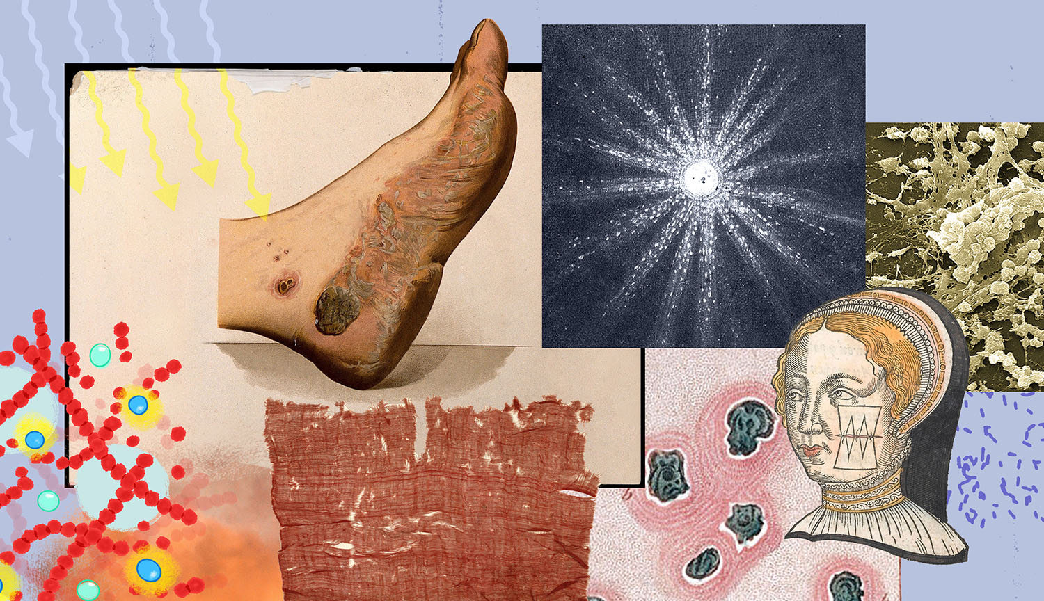 Illustration shows infected wounds, bacteria and light