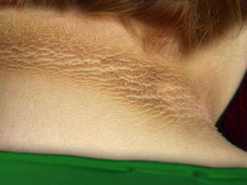 Photo of a person’s neck, showing darkly pigmented area.