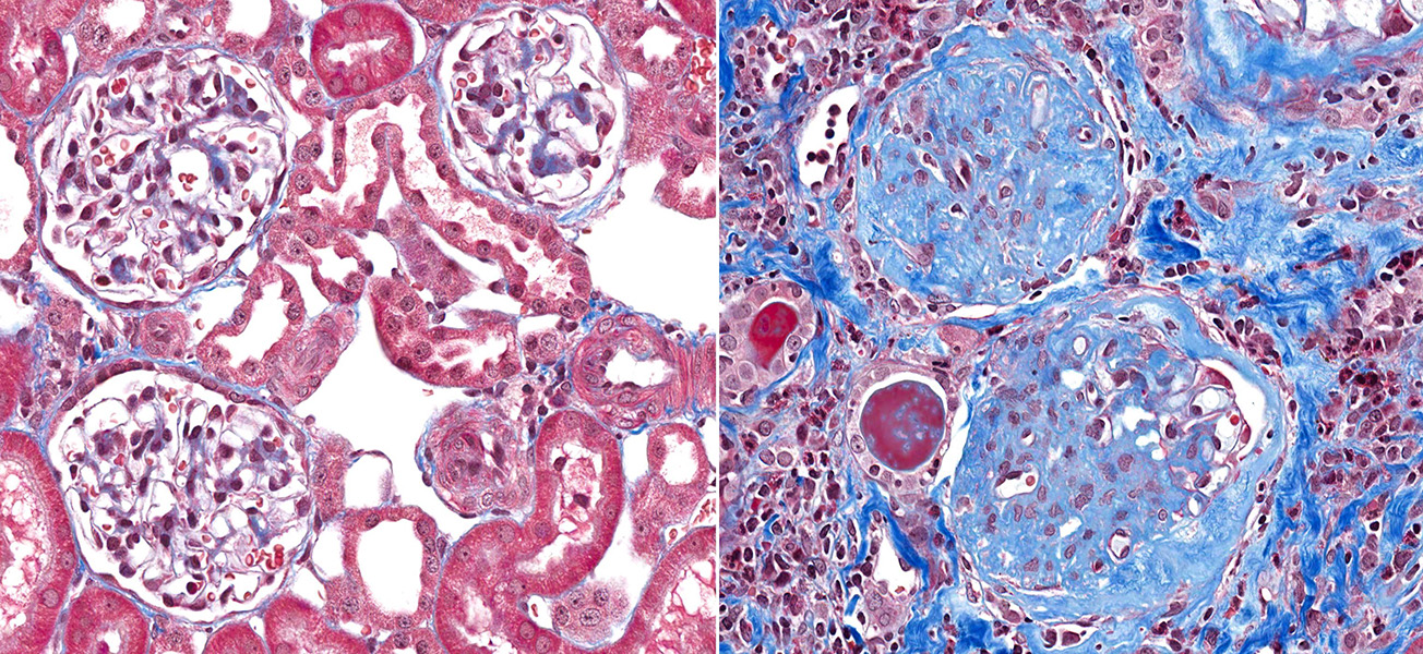 Two sections through kidney tissue, displayed side by side. On left, the tissue is largely pink. On the right, tissue shows a lot of blue coloration.