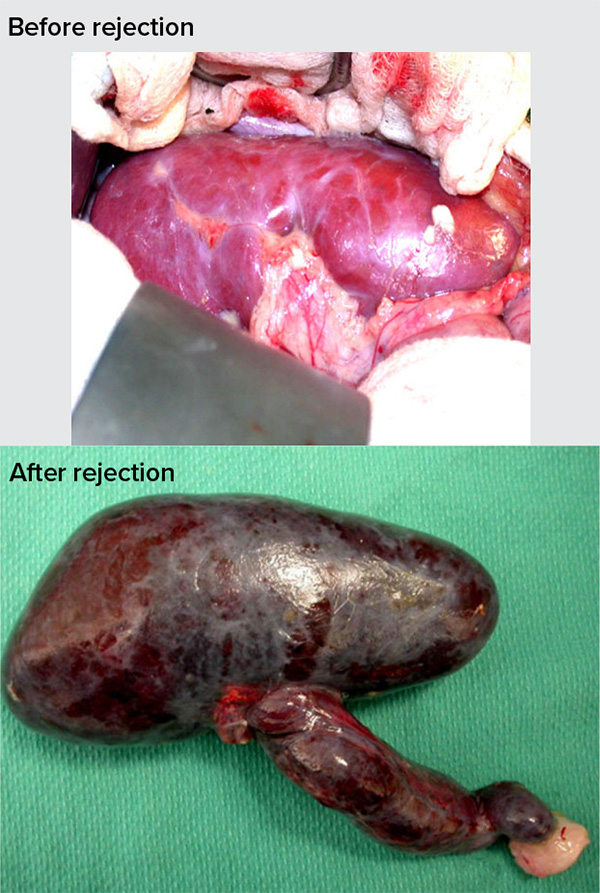 Two images show a healthy pink kidney and a black deadened one.