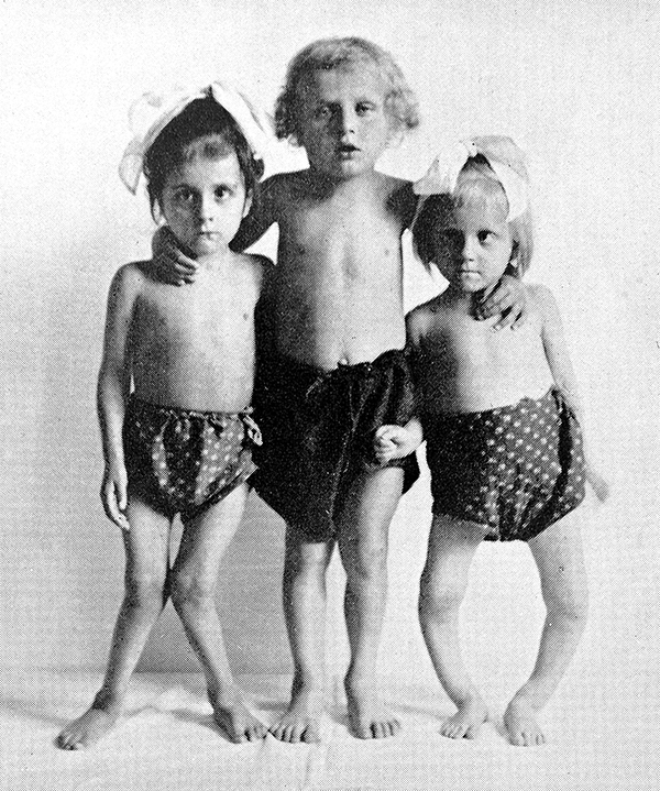 Three children with bowed legs face the camera in an old photograph.