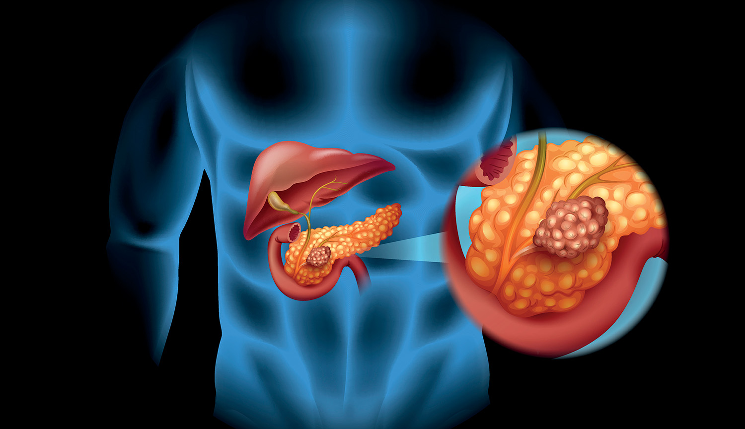 Progress fighting pancreatic cancer — one of the deadliest malignancies